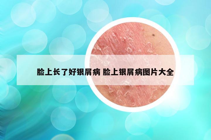 脸上长了好银屑病 脸上银屑病图片大全