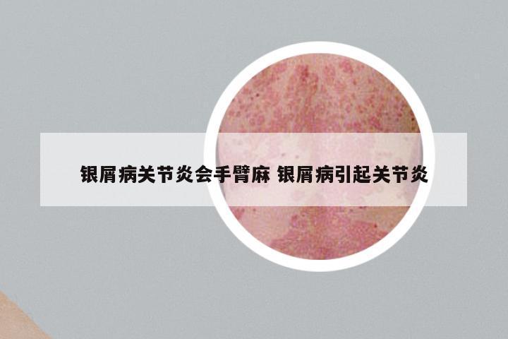 银屑病关节炎会手臂麻 银屑病引起关节炎