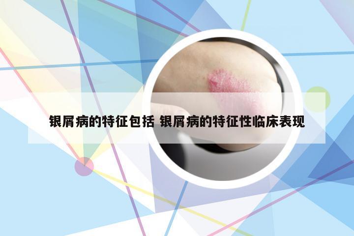 银屑病的特征包括 银屑病的特征性临床表现
