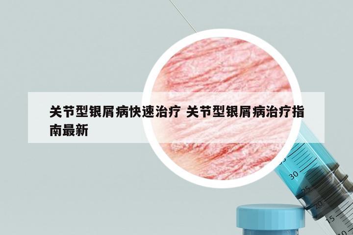 关节型银屑病快速治疗 关节型银屑病治疗指南最新