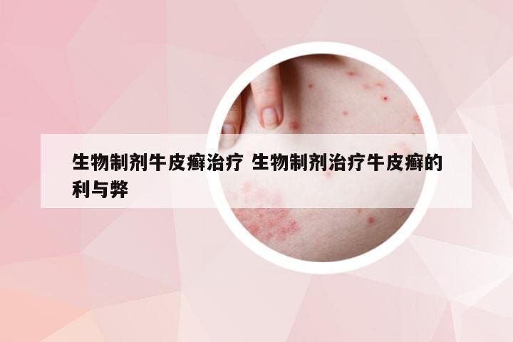 生物制剂牛皮癣治疗 生物制剂治疗牛皮癣的利与弊