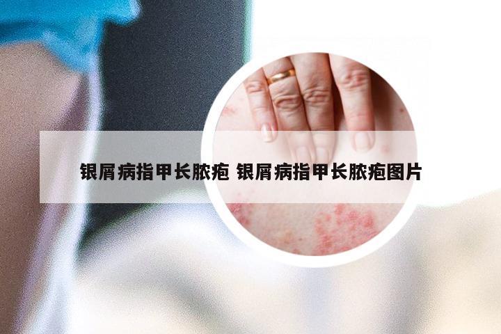 银屑病指甲长脓疱 银屑病指甲长脓疱图片