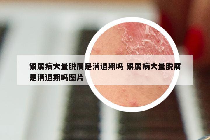 银屑病大量脱屑是消退期吗 银屑病大量脱屑是消退期吗图片