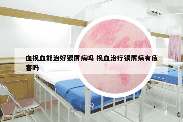 血换血能治好银屑病吗 换血治疗银屑病有危害吗