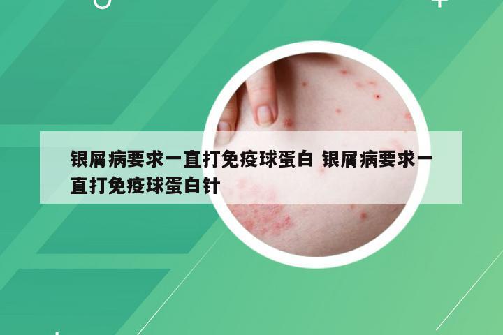 银屑病要求一直打免疫球蛋白 银屑病要求一直打免疫球蛋白针