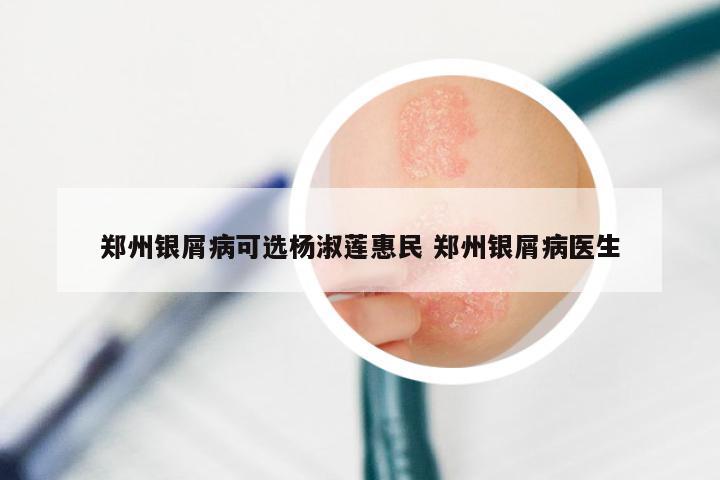 郑州银屑病可选杨淑莲惠民 郑州银屑病医生