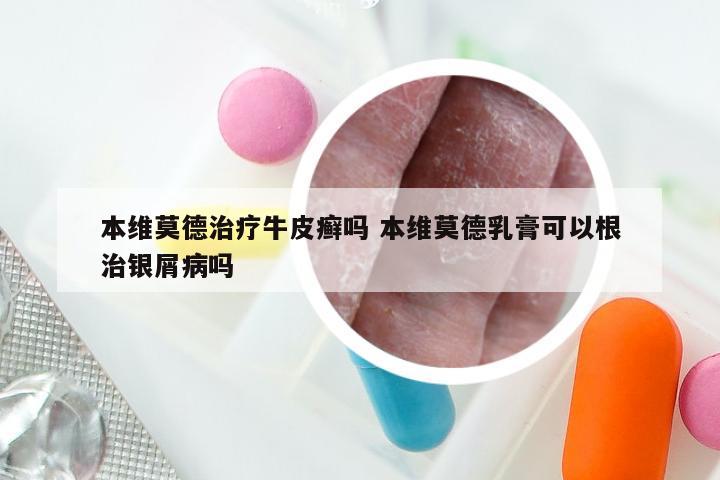 本维莫德治疗牛皮癣吗 本维莫德乳膏可以根治银屑病吗