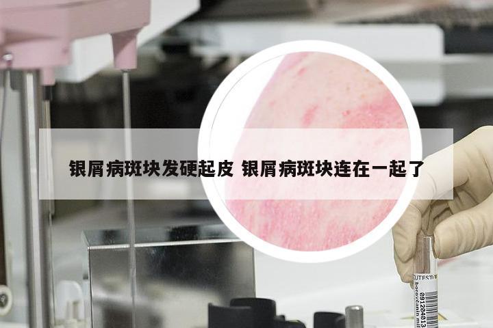 银屑病斑块发硬起皮 银屑病斑块连在一起了