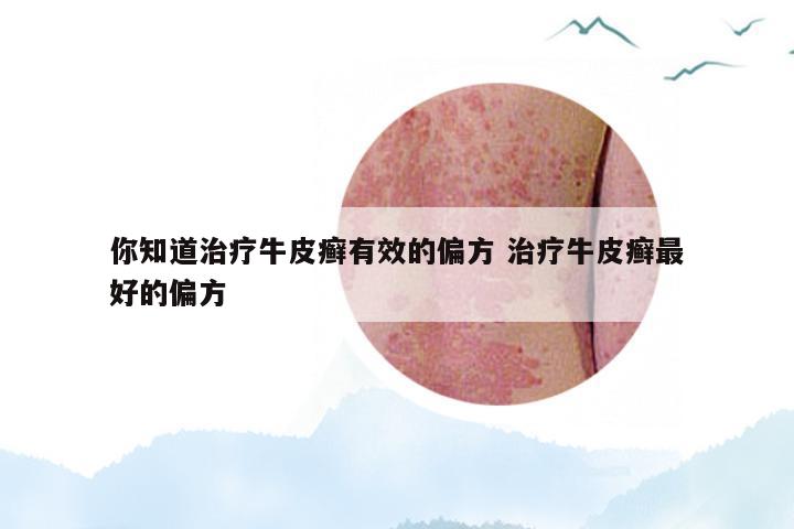 你知道治疗牛皮癣有效的偏方 治疗牛皮癣最好的偏方