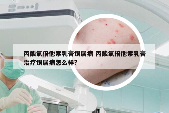 丙酸氯倍他索乳膏银屑病 丙酸氯倍他索乳膏治疗银屑病怎么样?