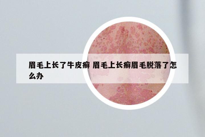 眉毛上长了牛皮癣 眉毛上长癣眉毛脱落了怎么办