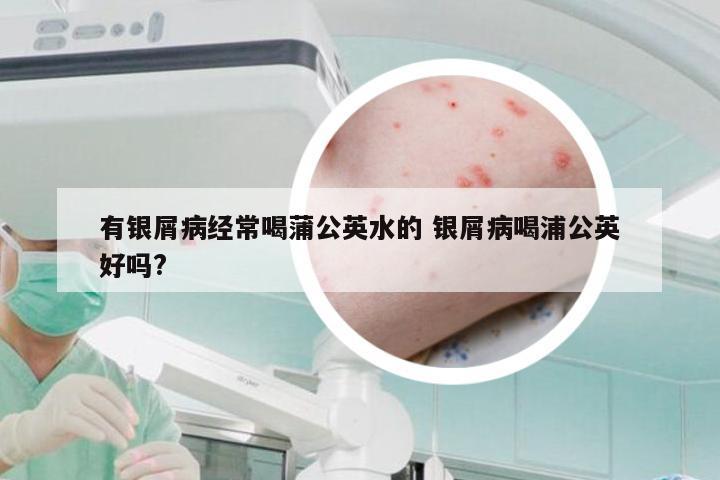 有银屑病经常喝蒲公英水的 银屑病喝浦公英好吗?