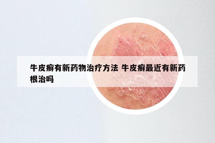 牛皮癣有新药物治疗方法 牛皮癣最近有新药根治吗