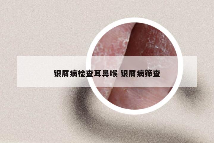 银屑病检查耳鼻喉 银屑病筛查