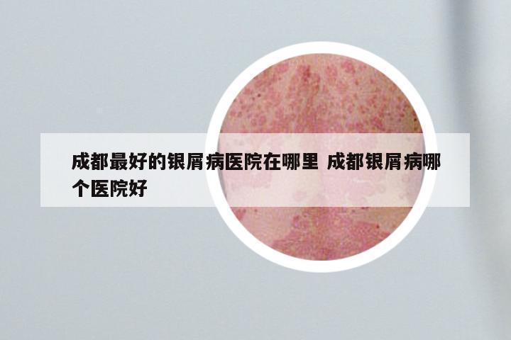 成都最好的银屑病医院在哪里 成都银屑病哪个医院好