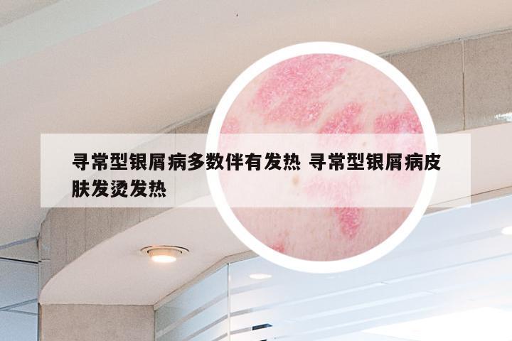寻常型银屑病多数伴有发热 寻常型银屑病皮肤发烫发热