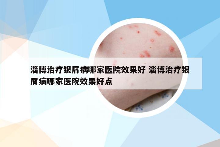 淄博治疗银屑病哪家医院效果好 淄博治疗银屑病哪家医院效果好点