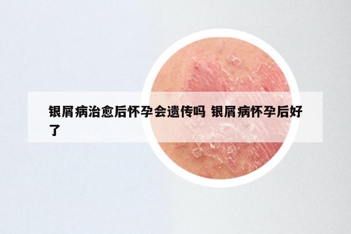 银屑病治愈后怀孕会遗传吗 银屑病怀孕后好了