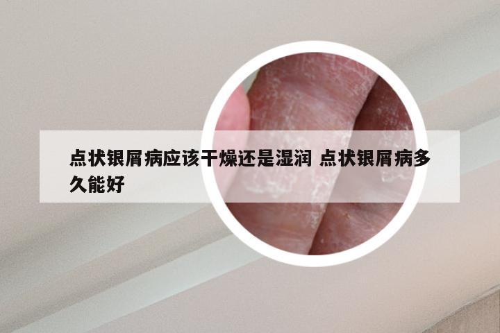 点状银屑病应该干燥还是湿润 点状银屑病多久能好