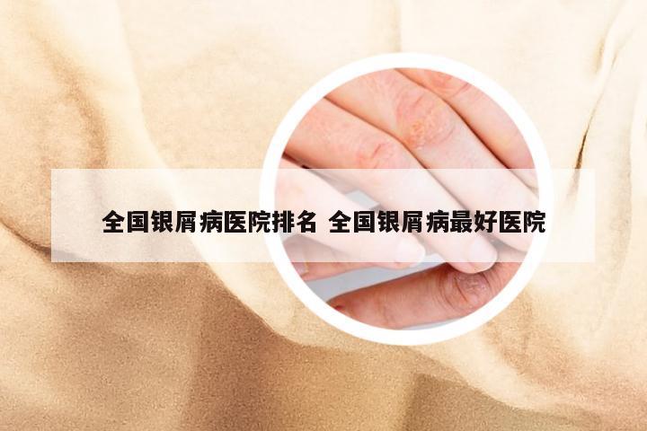 全国银屑病医院排名 全国银屑病最好医院