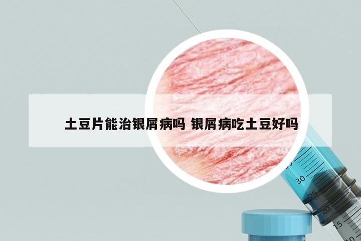 土豆片能治银屑病吗 银屑病吃土豆好吗