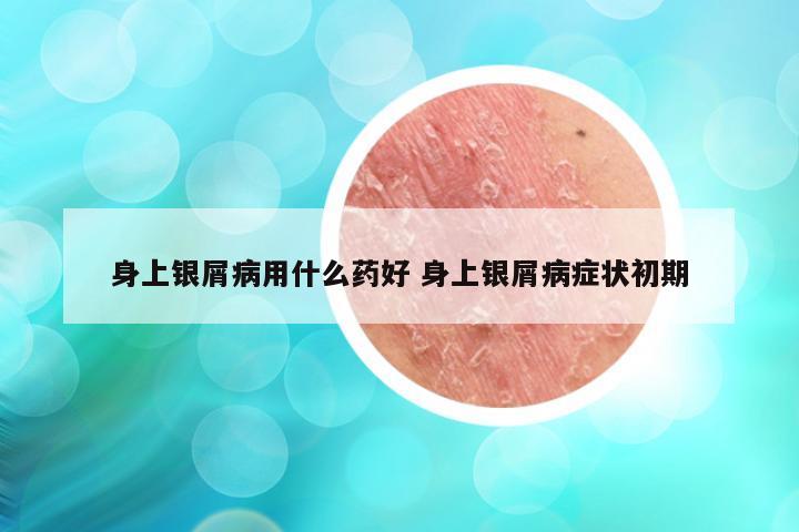 身上银屑病用什么药好 身上银屑病症状初期