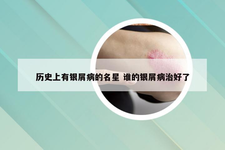 历史上有银屑病的名星 谁的银屑病治好了