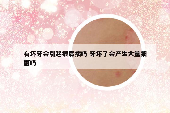 有坏牙会引起银屑病吗 牙坏了会产生大量细菌吗
