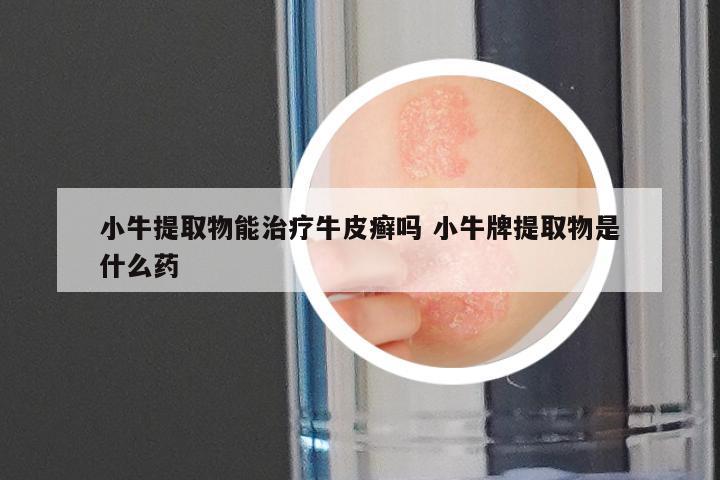 小牛提取物能治疗牛皮癣吗 小牛牌提取物是什么药