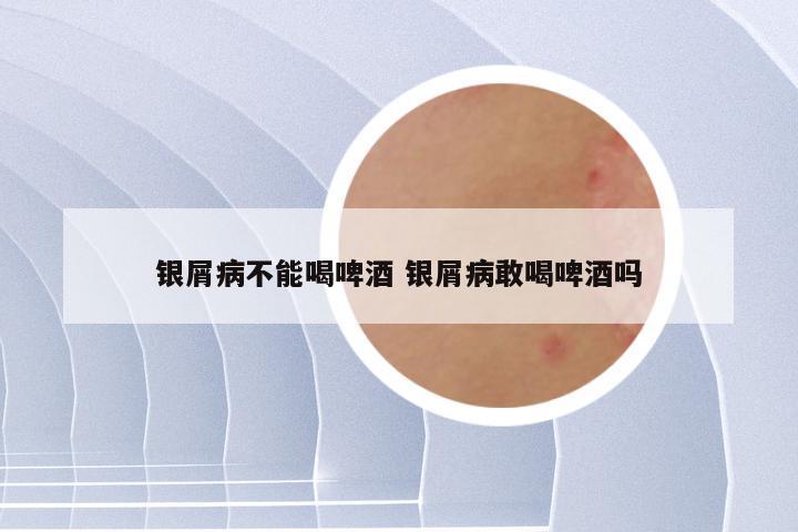 银屑病不能喝啤酒 银屑病敢喝啤酒吗