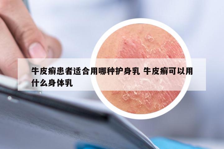牛皮癣患者适合用哪种护身乳 牛皮癣可以用什么身体乳