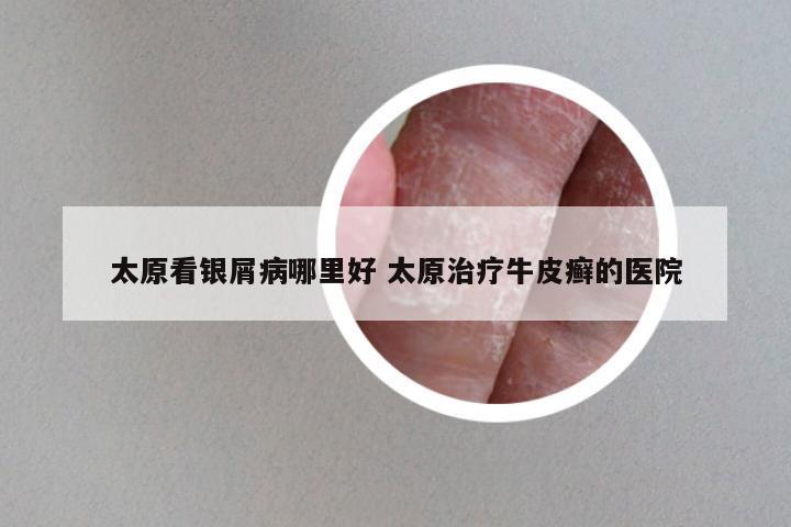 太原看银屑病哪里好 太原治疗牛皮癣的医院