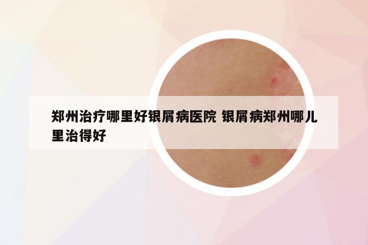 郑州治疗哪里好银屑病医院 银屑病郑州哪儿里治得好