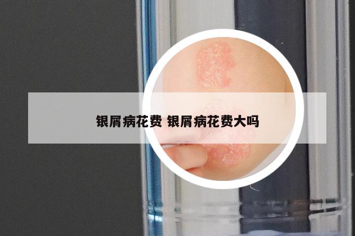 银屑病花费 银屑病花费大吗