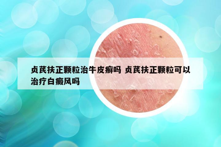 贞芪扶正颗粒治牛皮癣吗 贞芪扶正颗粒可以治疗白癜风吗