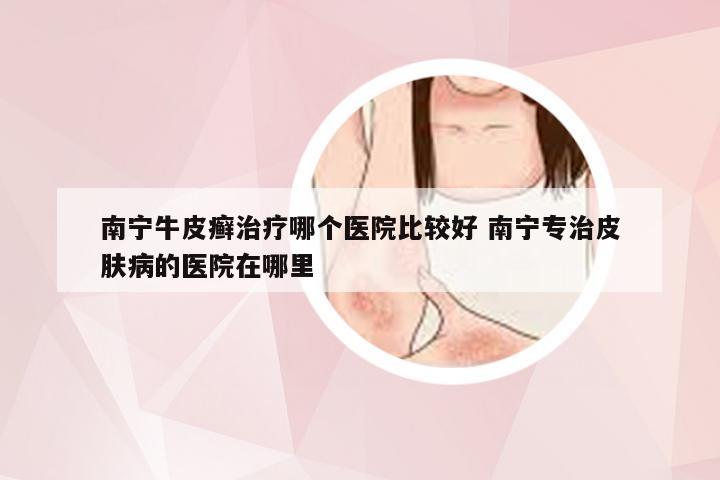 南宁牛皮癣治疗哪个医院比较好 南宁专治皮肤病的医院在哪里