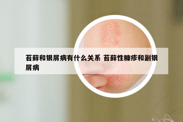 苔藓和银屑病有什么关系 苔藓性糠疹和副银屑病