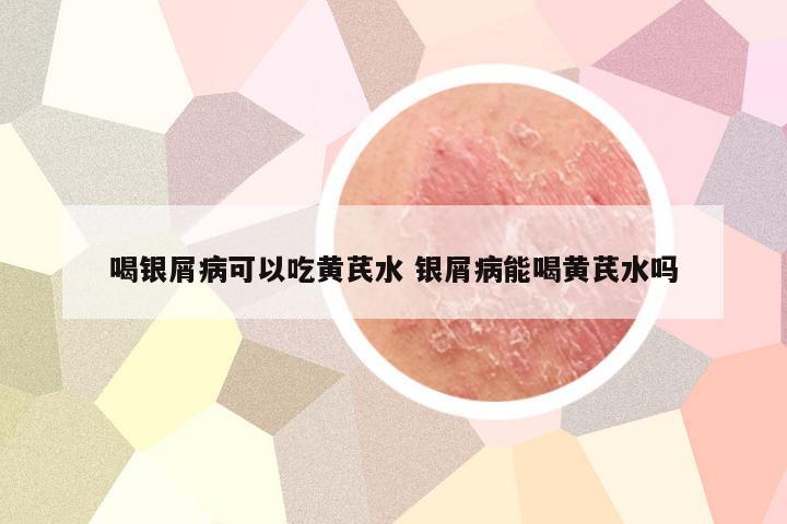 喝银屑病可以吃黄芪水 银屑病能喝黄芪水吗