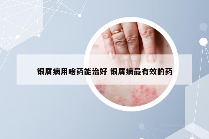 银屑病用啥药能治好 银屑病最有效的药