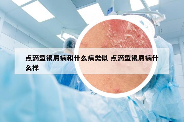 点滴型银屑病和什么病类似 点滴型银屑病什么样