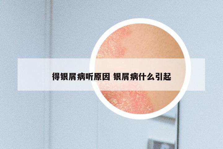 得银屑病听原因 银屑病什么引起