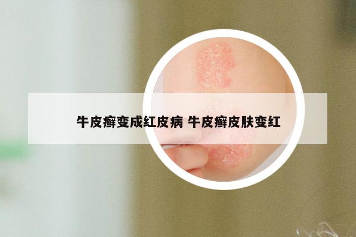 牛皮癣变成红皮病 牛皮癣皮肤变红