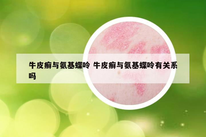 牛皮癣与氨基蝶呤 牛皮癣与氨基蝶呤有关系吗