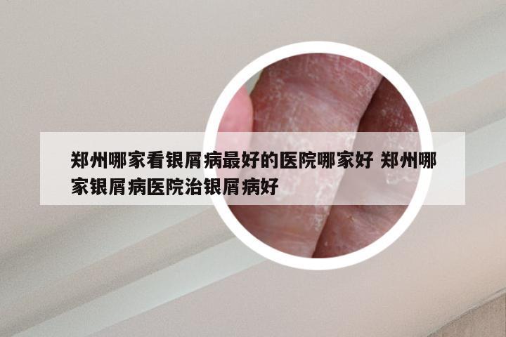 郑州哪家看银屑病最好的医院哪家好 郑州哪家银屑病医院治银屑病好