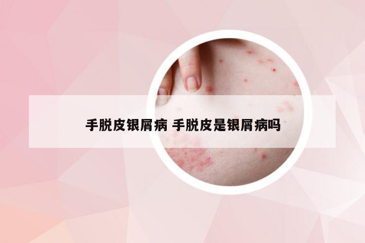手脱皮银屑病 手脱皮是银屑病吗