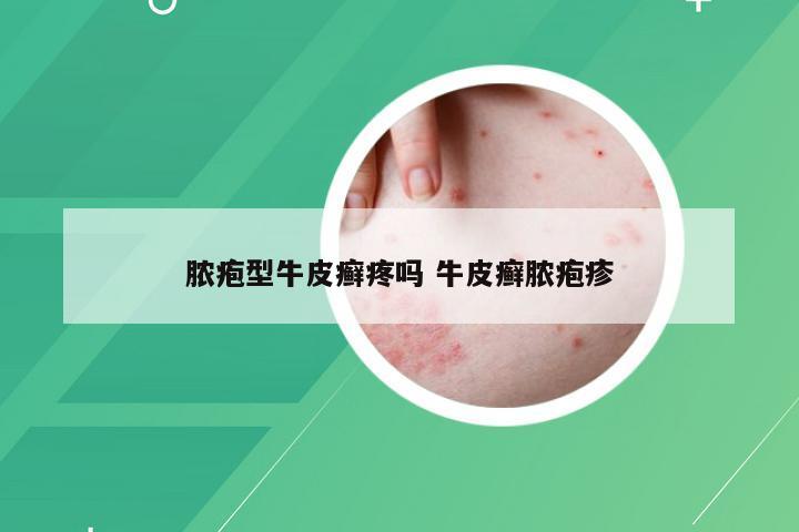 脓疱型牛皮癣疼吗 牛皮癣脓疱疹