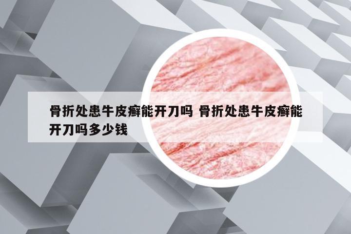 骨折处患牛皮癣能开刀吗 骨折处患牛皮癣能开刀吗多少钱