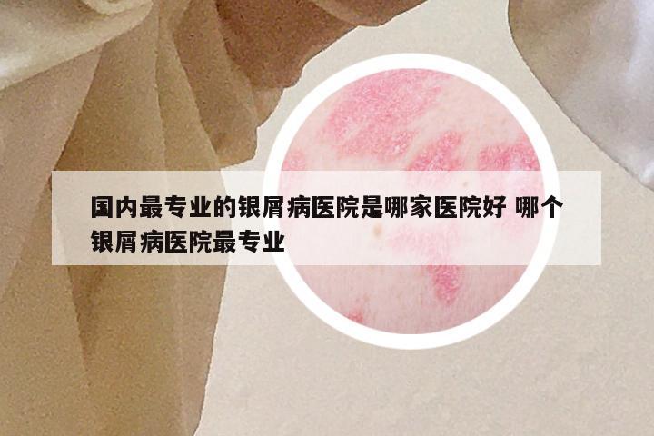 国内最专业的银屑病医院是哪家医院好 哪个银屑病医院最专业