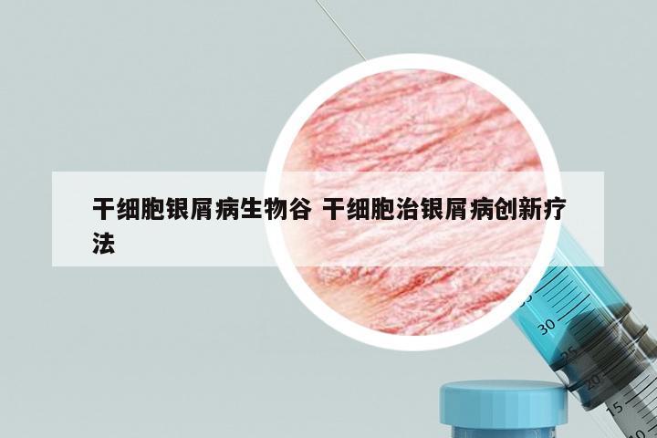 干细胞银屑病生物谷 干细胞治银屑病创新疗法