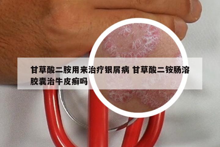 甘草酸二胺用来治疗银屑病 甘草酸二铵肠溶胶囊治牛皮癣吗